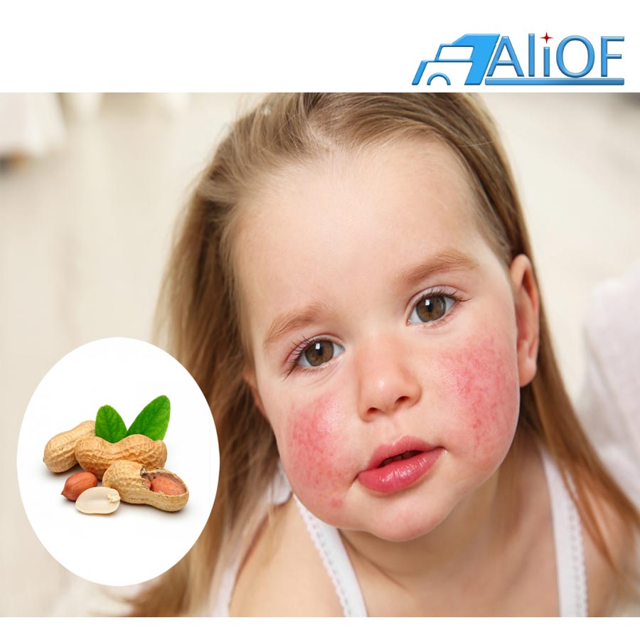 Пищевая аллергия – это повышенной чувствительности организма к пищевым продуктам, которое развивается при нарушении иммунной системы